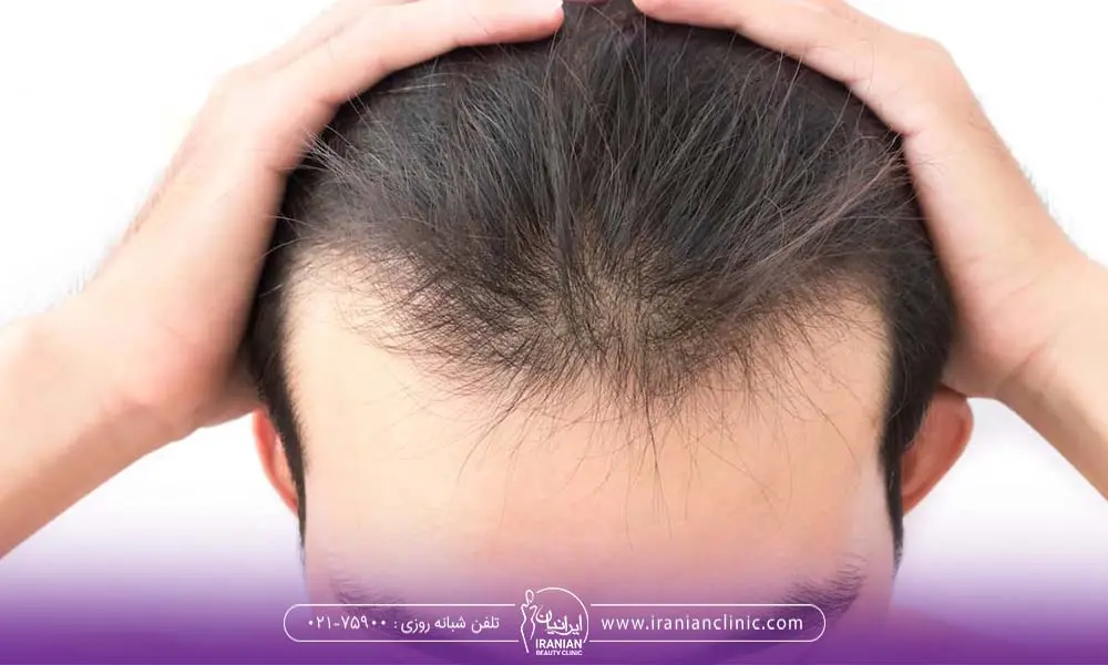 بهترین زمان کاشت مو چه زمانی است؟