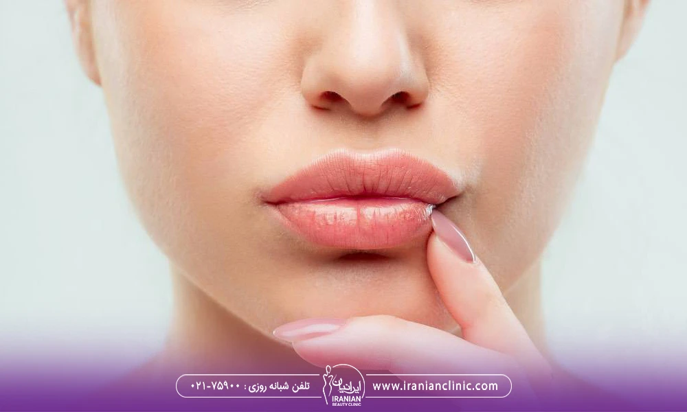 دختر با لب های حجیم - تزریق ژل لب مدل فانتزی