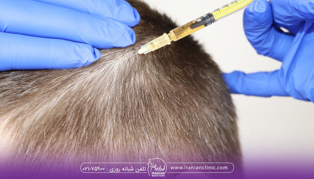 تاثیر مزوتراپی مو