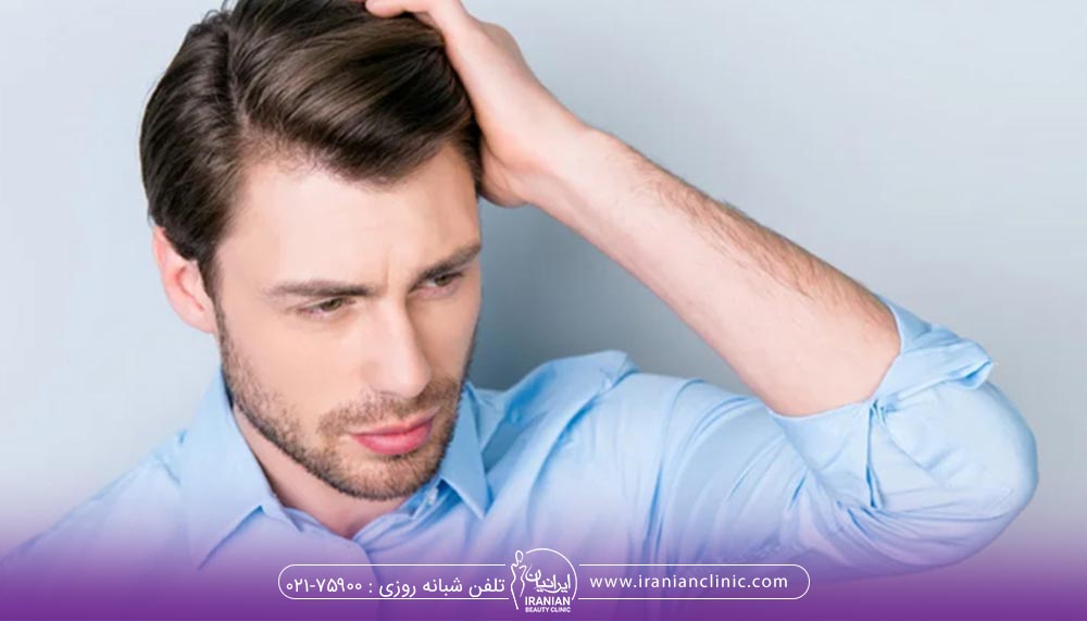 سیگار کشیدن قبل از کاشت مو