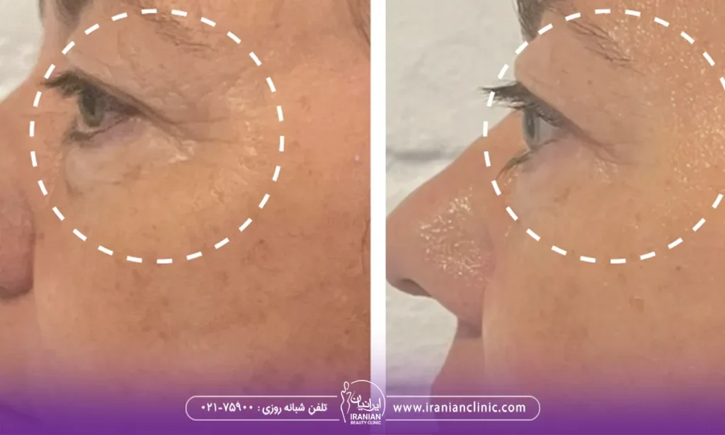 خانمی در حال هایفوتراپچی دور چشم برای از بین بردن چروک دور چشم وتیرگی ان، هایفوتراپی دور چشم