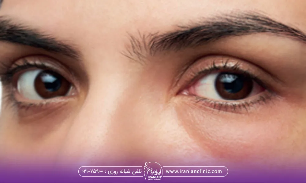 یک خانم که رو به رو را نگاه میکند و زیر چشمش ورم کرده است