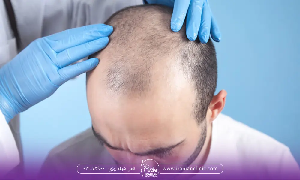 ایا امکان دارد موهای کاشته شده رشد نکنند