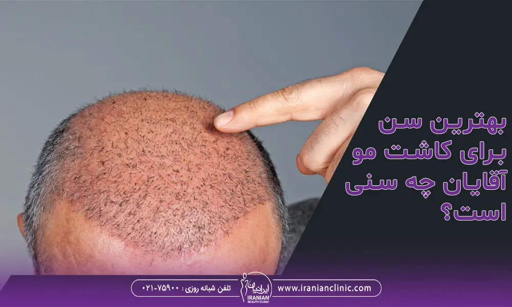 بهترین سن برای کاشت مو آقایان چیست؟