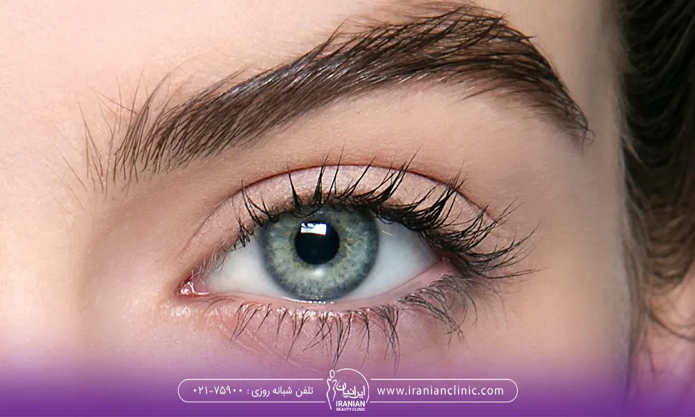 علت ریزش ابروها بعد از کاشت چیست ؟