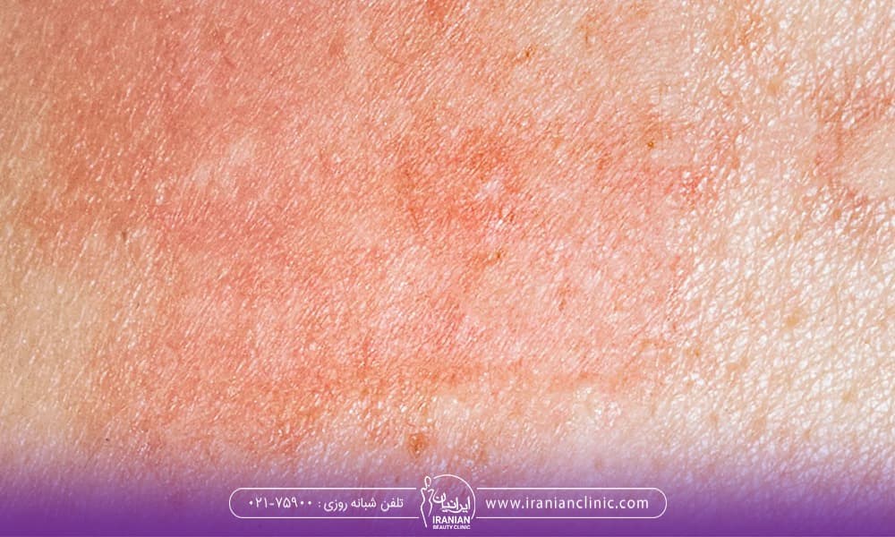سوختن پوست با لیزر موهای زائد
