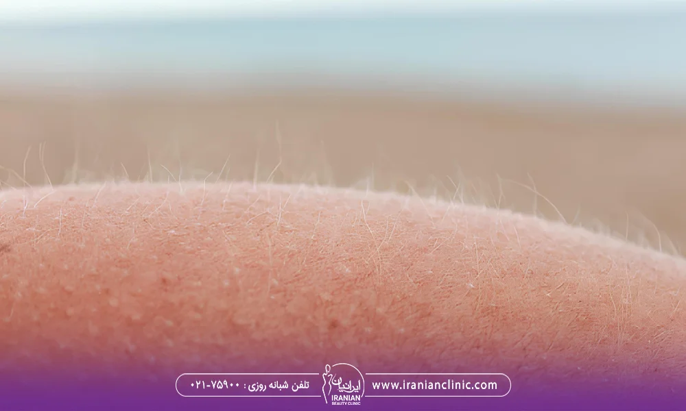 موهای سفید کوچک روی پوست