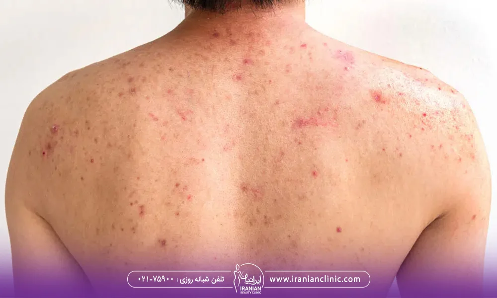 عکس کتف و کمر یک مرد که جوش زده است