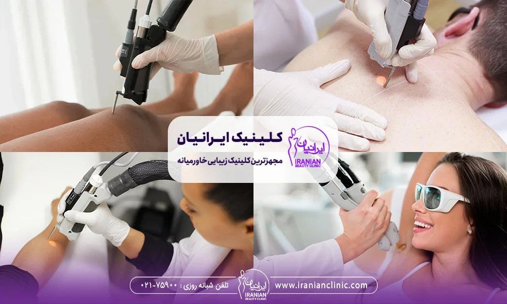 4 عکس مربوط به لیزر روی کتف مرد و لیزر روی پاهای زن و لیزر زیر بغل زن و لیزر روی دست زن
