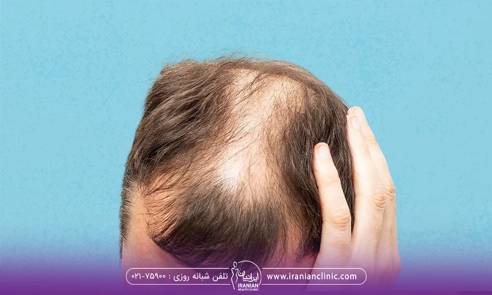 موی سر یک آقا که از وسط مو ریخته شده
