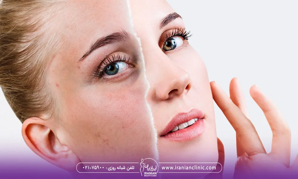 تصویر مربوط به یک خانم است که چشمهای رنگی و موهای قهوه ای روشن دارد و قبل و بعد سابسیژن توی عکس با یک خط فرضی مشخص شده است.