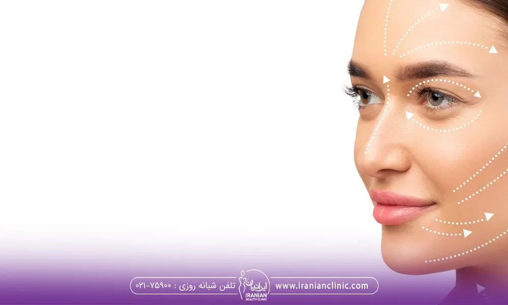 روی صورت یک خانم که لبخند دارد خطوط اندولیفت مشخص شده است