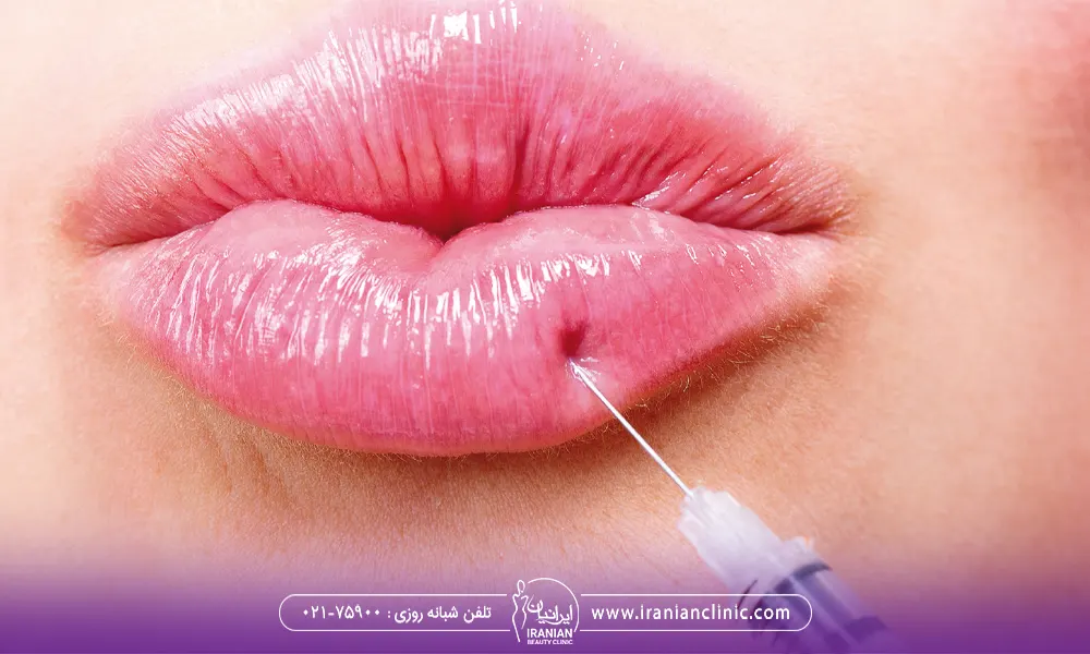 تزریق ژل به لب که ممکن است در صورت رعایت نکردن نکات به نیکروز لب منجر شود