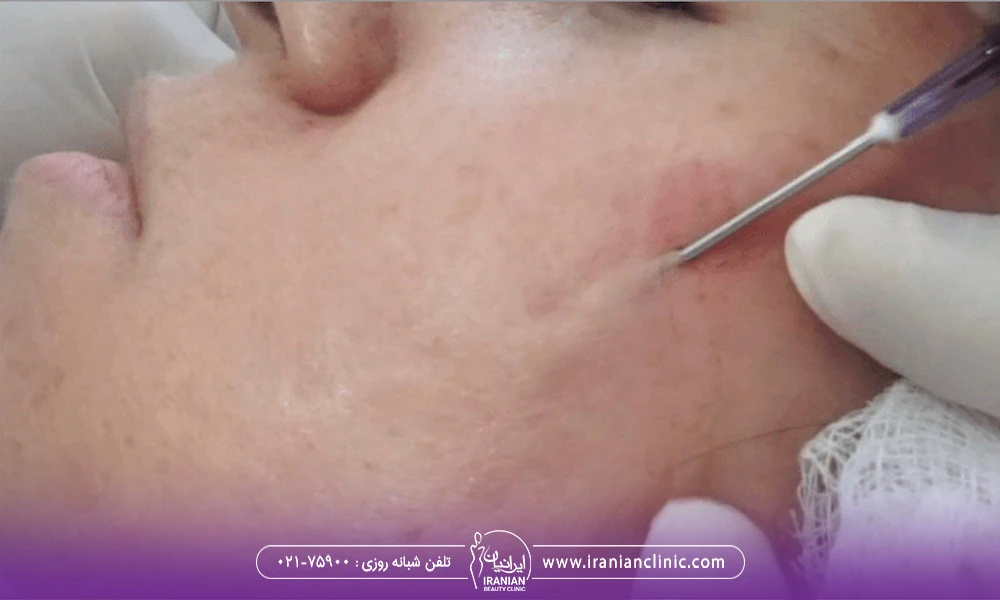 پزشک در حال فرو کردن سوزن به زیر سطح پوست فرد - بهترین مرکز سابسیژن در تهران