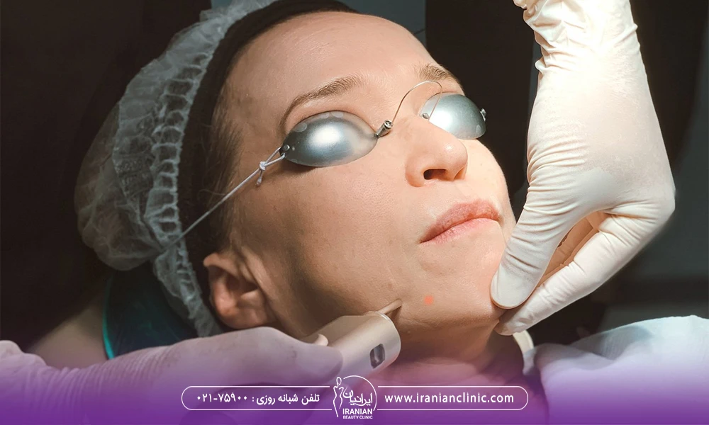 صورت زن که پزشک هندپیس دستگاه لیزر فوتونا را روی آن قرار داده - بهترین مرکز لیزر فوتونا در تهران
