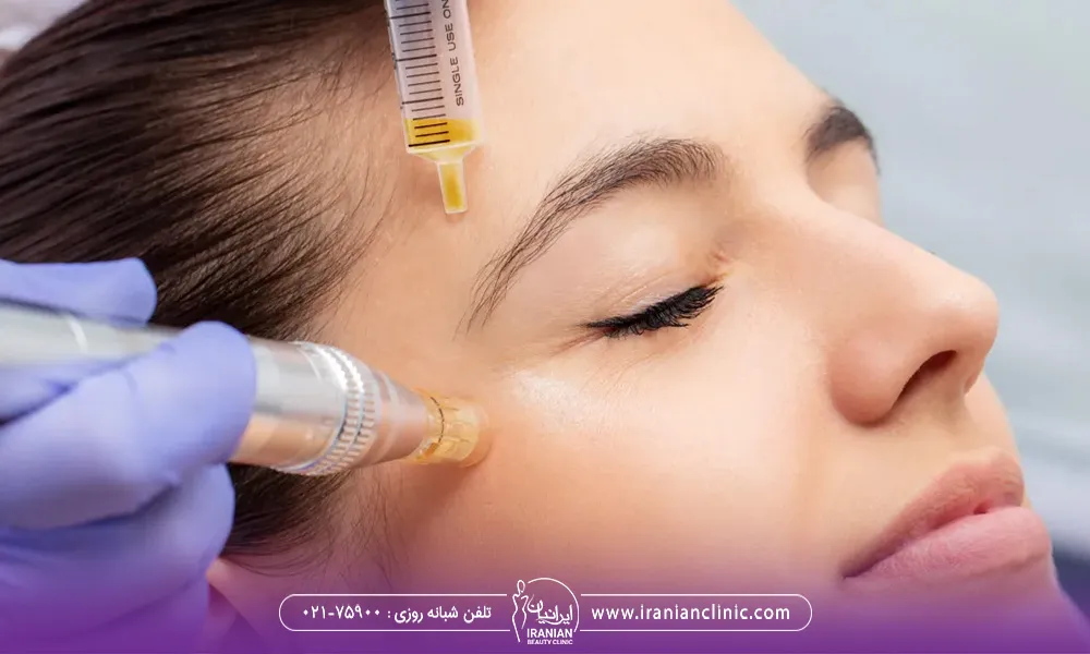 تصویر صورت یک خانم است که در حال انجام مزونیدلینگ روی صورتش هست