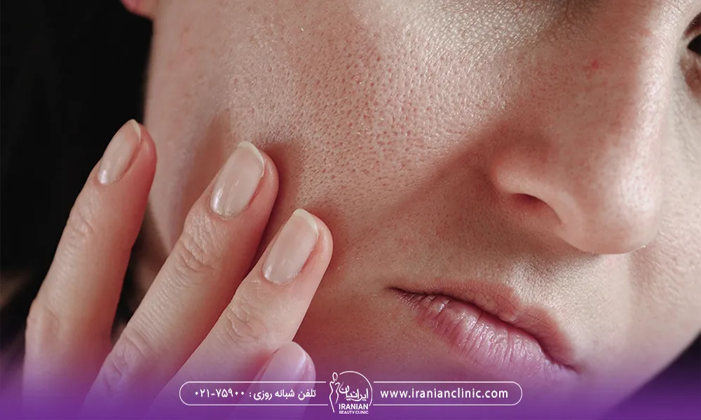نیمه ی صورت یک خانم است که با انگشتان دستش به منافذ باز صورتش اشاره می کند