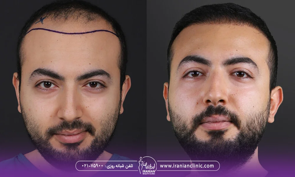 عکس قبل و بعد از مردی که ریش بلندی دارد و کاشت مو انجام داده است - کاشت مو از ریش به سر