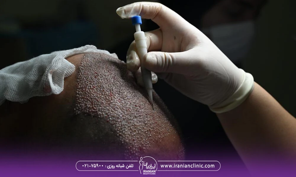 پزشکی که با پانچ مخصوص روی سر مرد کاشت DHI انجام می دهد