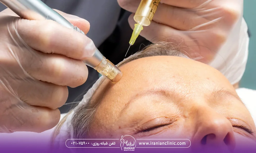 پزشکی که پیشانی فرد را مزو می کند - مراقبت های بعد از مزونیدلینگ