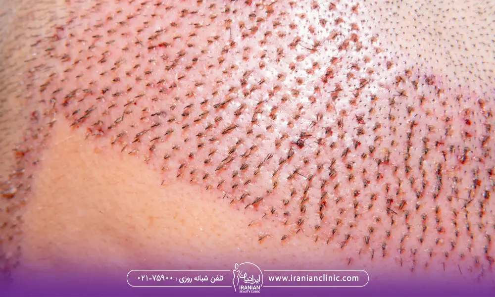 خط رویش مرد که در آنجا پیوند فولیکول انجام شده است و دچار قرمزی شده است - معایب کاشت مو به روش تکثیر