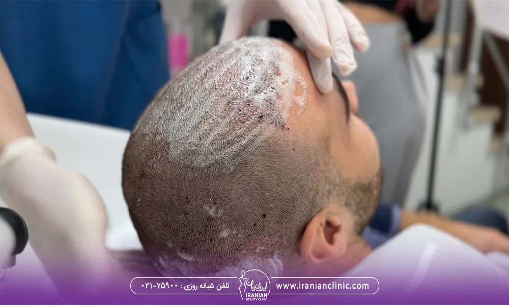 فردی سر مرد را بعد از کاشت مو با شامپو می شوید - شستشوی سر پس از کاشت مو
