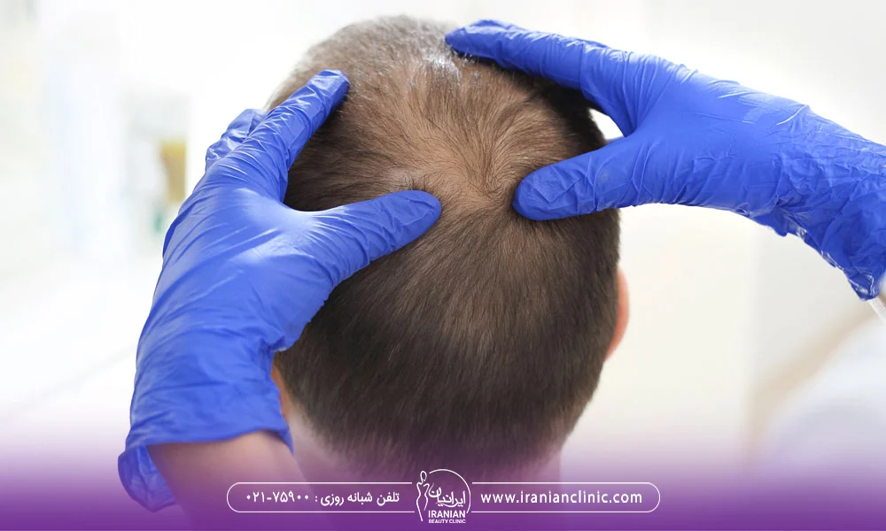 پزشکی که ناحیه طاس سر مرد را معاینه می کند - کاشت مو میکرو ایمپلنت