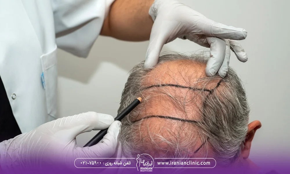 پزشکی که روی ناحیه طاس سر مرد مسن طراحی کرده است تا کاشت مو انجام دهد