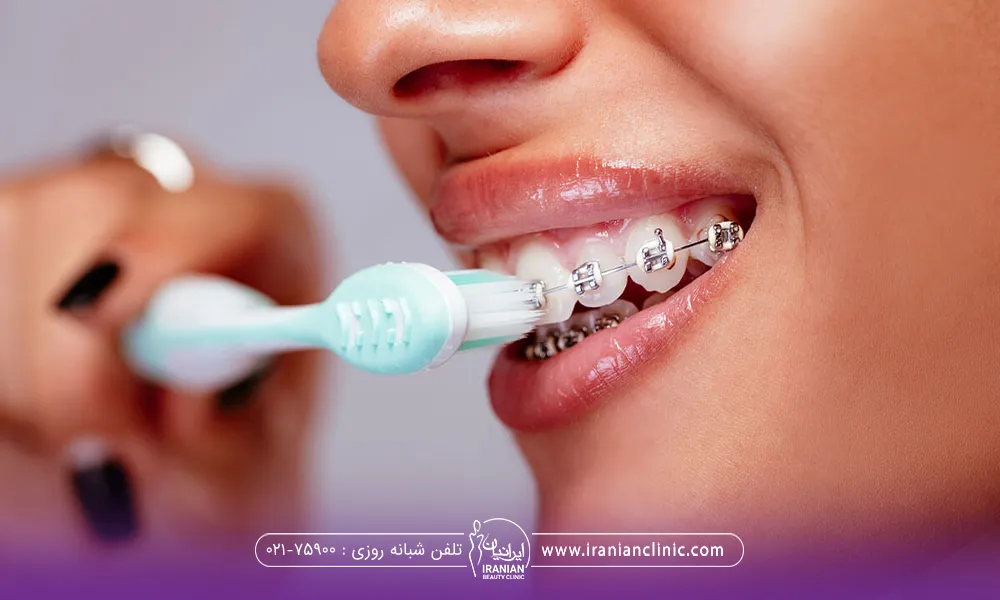 دختری که در حال مسواک زدن است و دندان های او اورتودنسی شده است - مسواک زدن بعد از تزریق ژل لب​