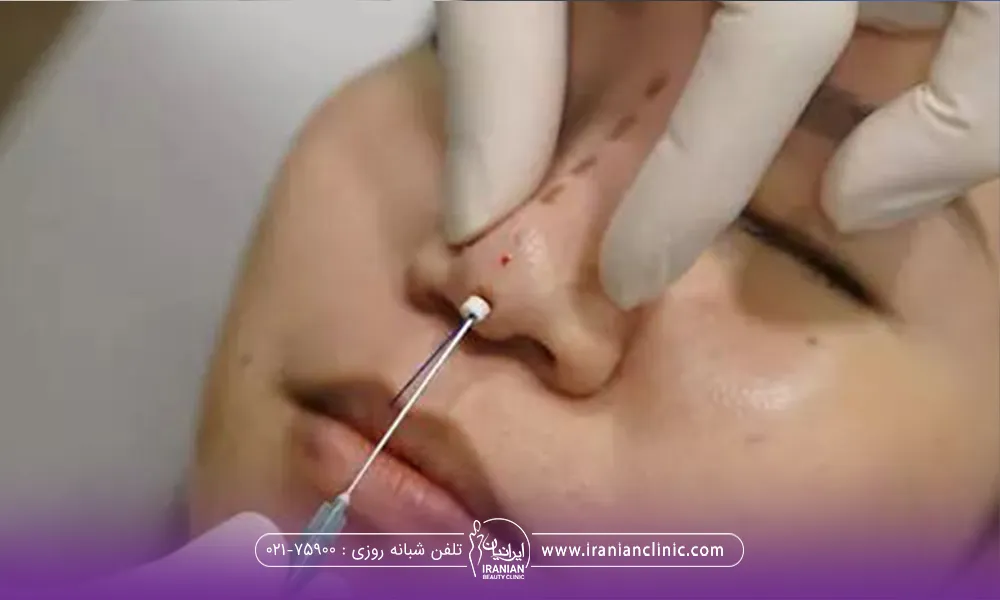 فردی که خوابیده است و روی بینیش چند تا نقطه چین علامت گذاشتند و دستان دکتری که سر سوزن نخ لیفت را داخل نوک بینی فرد فرو برده است - مراقبت های بعد از لیفت بینی با نخ​