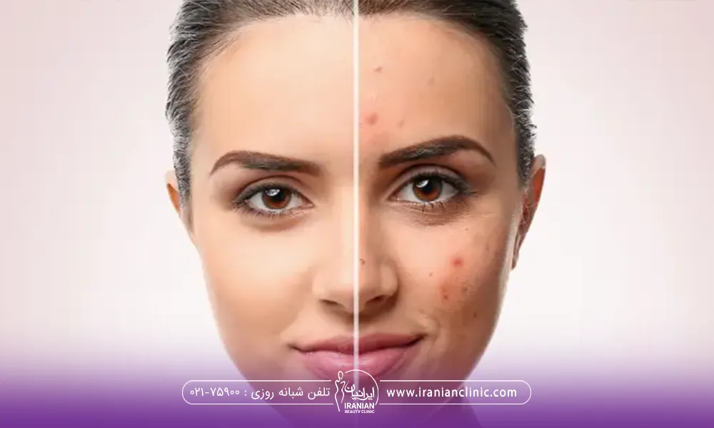 صورت خانمی که با خط از وسط به دو نیمه تقسیم شده است و سمت راست صورت پوستی جوش دار و کدر و در سمت چپ صورت پوستی شاداب و صاف است - مراقبت های بعد از سابسیژن
