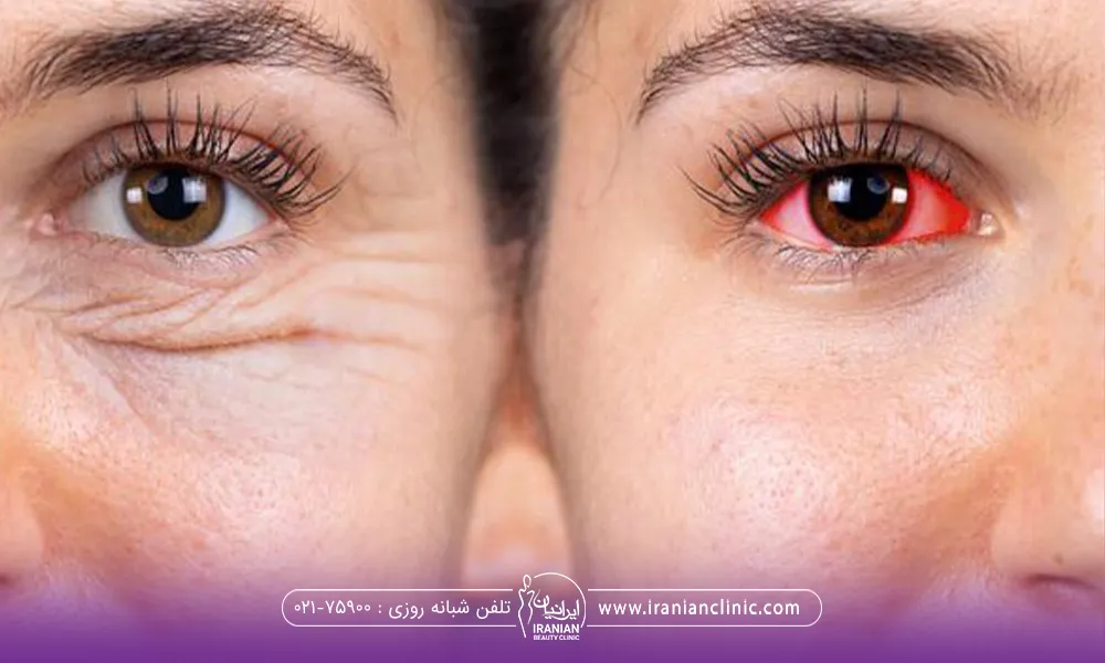 خانمی که عمل بلفارو پلاستی انجام داده است و یک چشمش قرمز شده است - عوارض بلفاروپلاستی