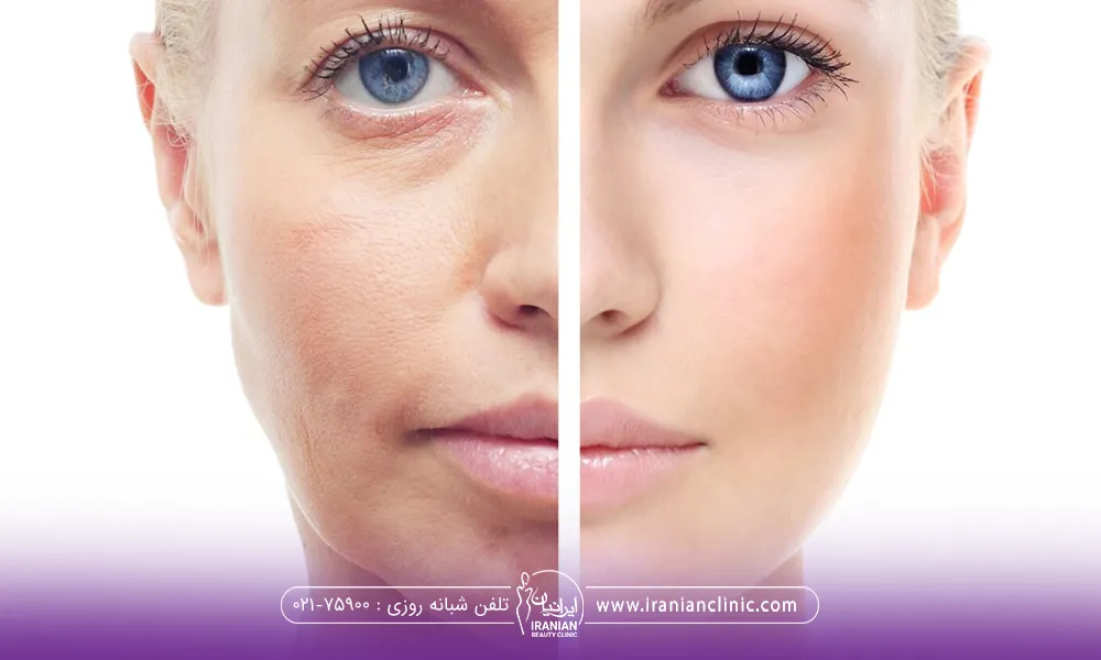 عکس قبل و بعد و تغییرات پوست در اثر تزریق مزوژل - عوارض مزوژل صورت​