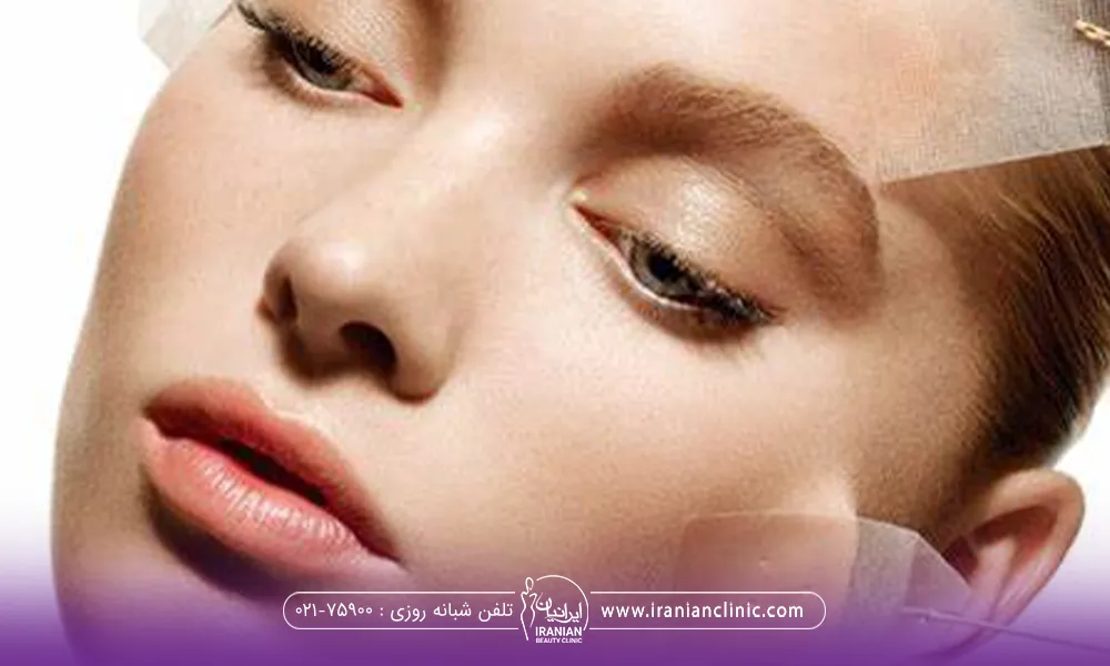 صورت دختر جوان که چند چسب روی پوست او قرار گرفته و این چسب ها پوست او را می کشد - هزینه لیفت صورت