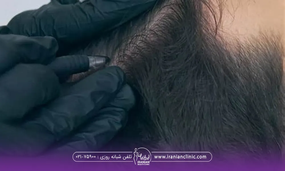 فردی که سرش را تکیه داده است و دست دکتر با دستکش مشکی در حال تزریق هیر فیلر مو می باشد - بهترین کلینیک هیر فیلر مو در تهران