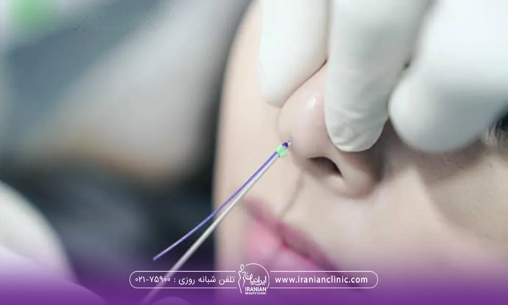 پزشکی که نخ لیفت را در نوک بینی دختر فرو می کند - ماندگاری لیفت بینی با نخ