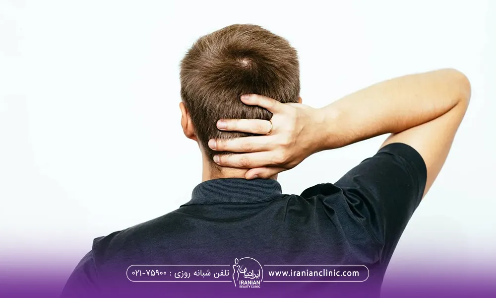 عکس مردی از پشت که پشت سر خود را با دستش گرفته است - درد پشت سر بعد از کاشت مو