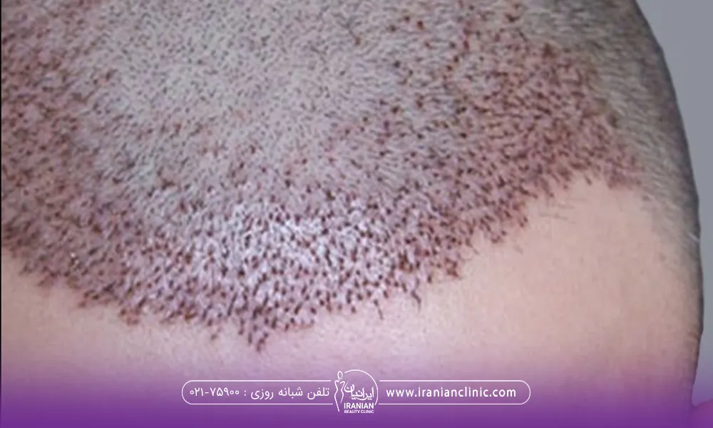 تصویر سر مرد که بعد از کاشت مو دچار زخم شده است - دلمه های بعد از کاشت مو
