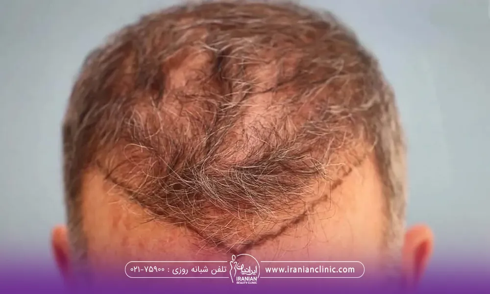 سر مردی که موهای او کم پشت است و روی پیشانی اش خط کشیده شده است