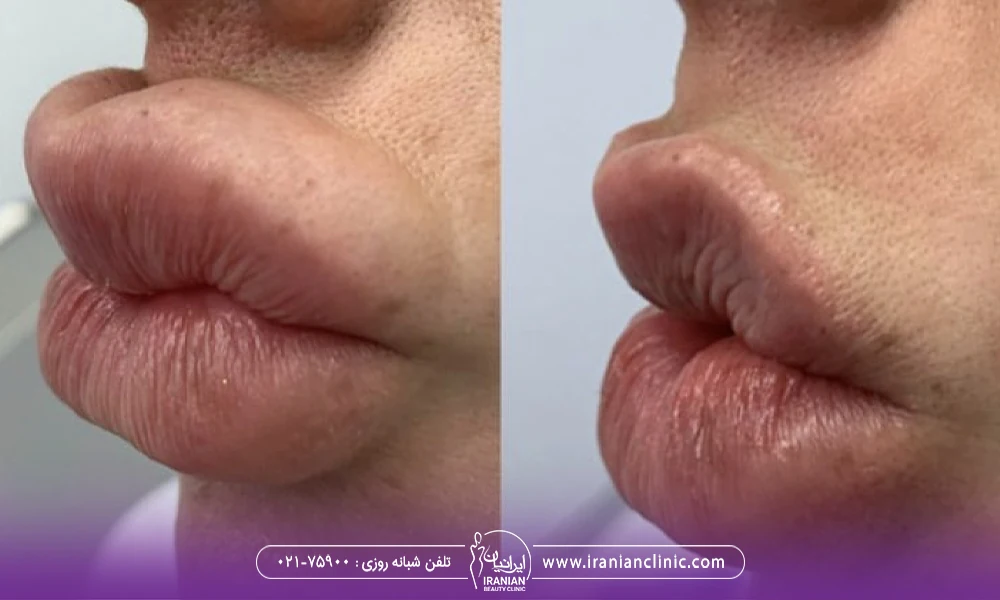 عکس قبل و بعد تزریق فیلر به لبهای دختری که پس از تزریق لب های او اردکی شده است - تزریق ژل لب اردکی