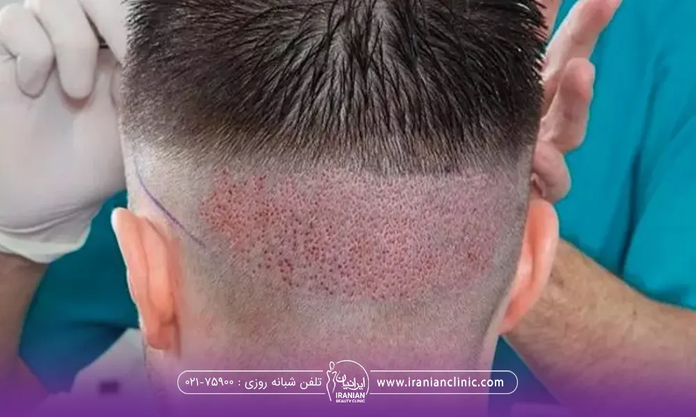 پشت سر پسر که فولیکول های مو از آنجا برداشته شده است