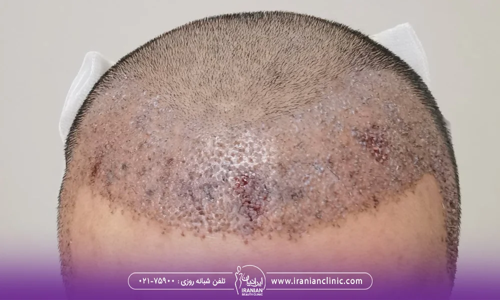 مردی که به تازگی کاشت مو انجام داده و پشت سر او بانداژ دارد و جلوی سر او دچار کبودی و خون مردگی شده