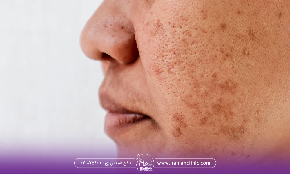 صورت دختری که دچار لکه های قهوه ای روی پوست شده است - لکه های قهوه ای بعد از لیزر موهای زائد