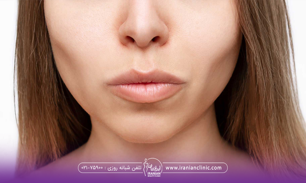 عکس از صورت دختری که بوکال فت انجام داده است - بهترین کلینیک بوکال فت در تهران