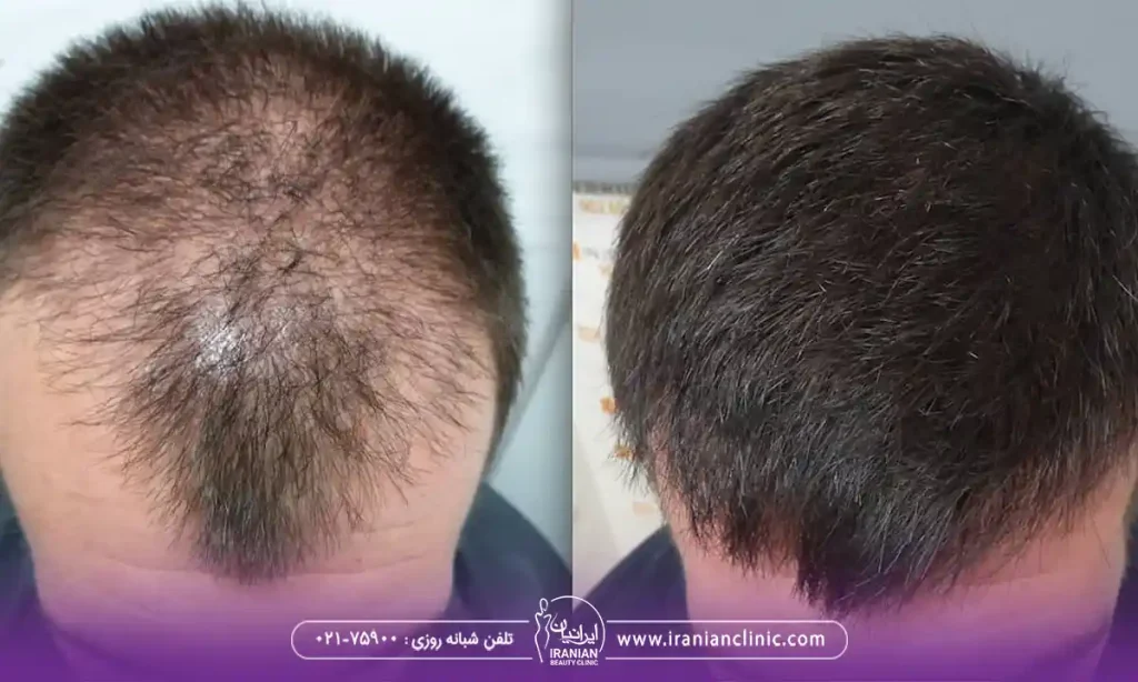 قیمت کاشت مو به روش sut و هزینه کاشت مو به روش SUT