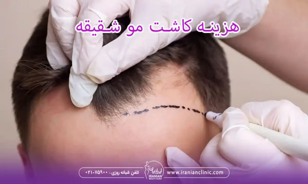 هزینه کاشت مو شقیقه و قیمت کاشت مو شقیقه