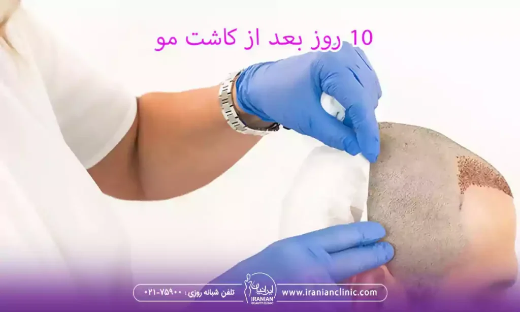 10 روز بعد از کاشت مو و همه چیز درمورد کاشت مو بعد از 10 روز