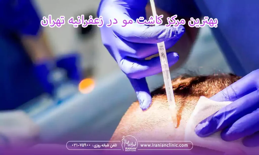  بهترین مرکز کاشت مو در زعفرانیه تهران