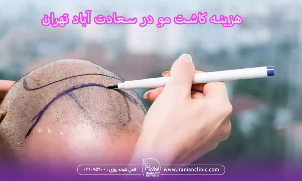 هزینه کاشت مو در سعادت آباد تهران و قیمت کاشت مو سعادت آباد تهران