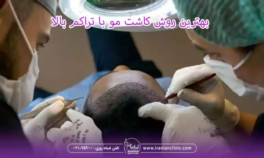 بهترین روش کاشت مو با تراکم بالا